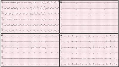 Frontiers Case Report Acute Fulminant Myocarditis And Cardiogenic